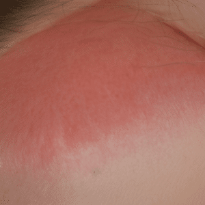 Close up look at rashes cause by latex allergies